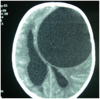 Figure-2: Large single cyst